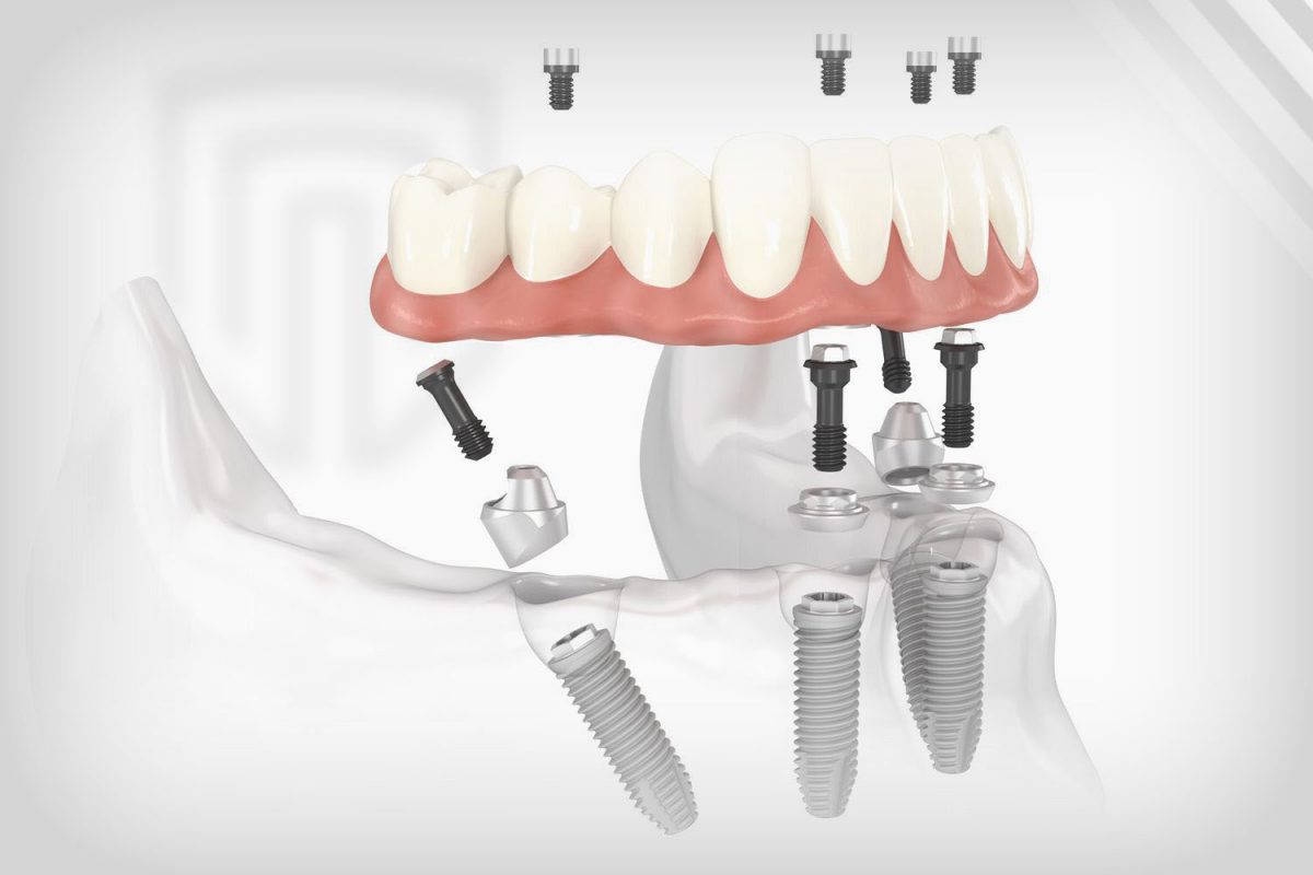 Replacing All Teeth With Dental Implants