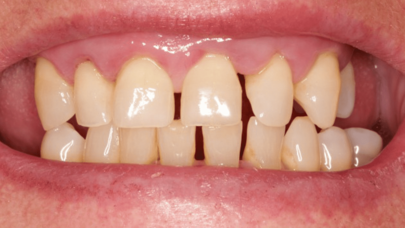 Wobbly Teeth before dental implants
