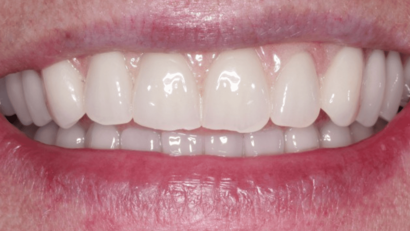 wobbly teeth after dental implants