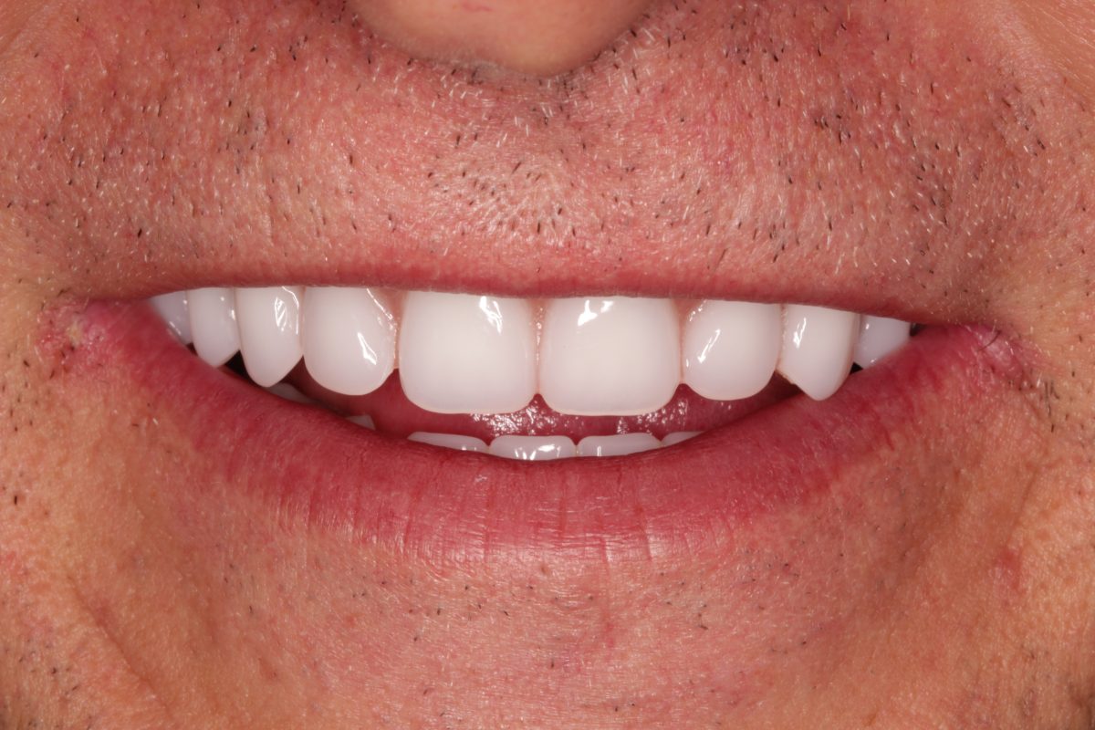 wobbly teeth solved by dental implants