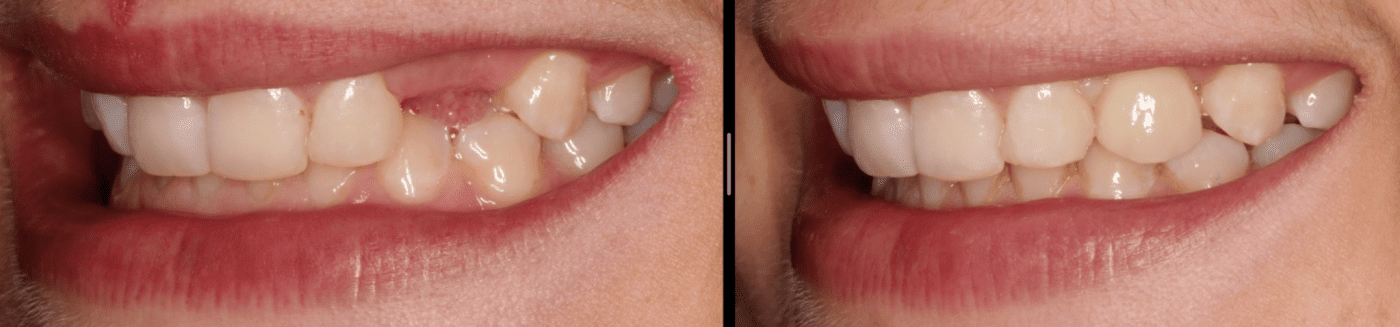 Am I too young for a dental implant? Before and After implant