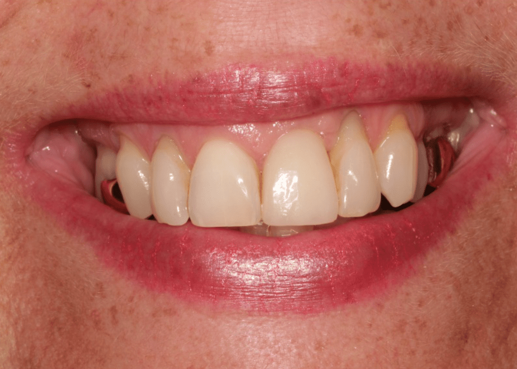 How natural will my implant look? After