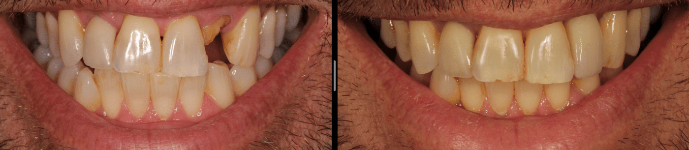 tooth snapped before and after dental implant